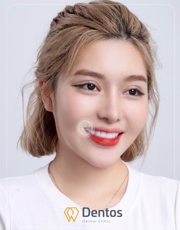 Dentos là địa chỉ bọc răng sứ uy tín của hơn 8000 khách hàng mỗi năm.